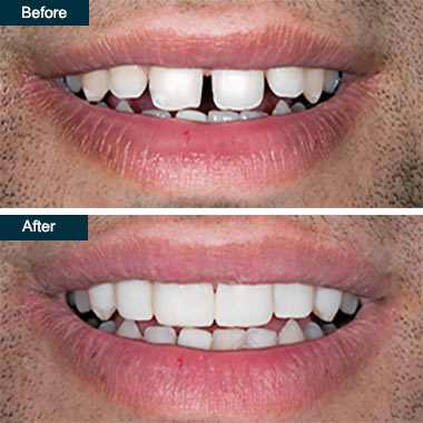 Cosmetic Resin Bonding, Advanced Dentistry