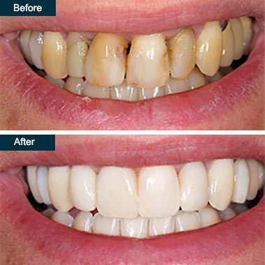 Before After Dental Deep Teeth Cleaning Yonkers NY 
